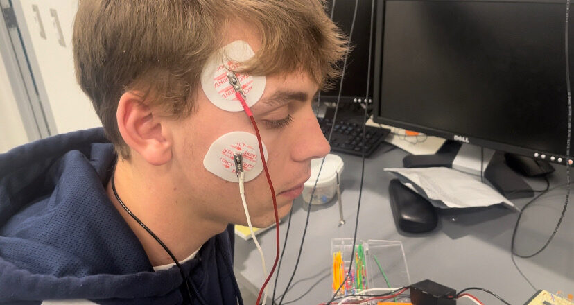 Electrodes above the eyebrow and on the cheekbone — the placement that finally worked.